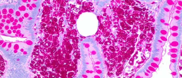 Image d'une coloration HE - Néoplasme papillaire intraductal dans le foie Hilum