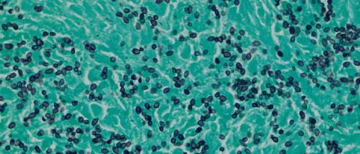 Image d'une coloration argentique - Histoplasmose de l'intestin grêle