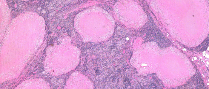 Image d'une coloration HE - Tuberculose dans un ganglion lymphatique
