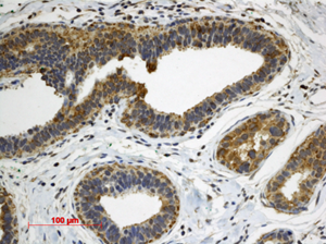Famille de protéines NF-κB : immunohistochimie de l'hyperplasie mammaire d'une patiente