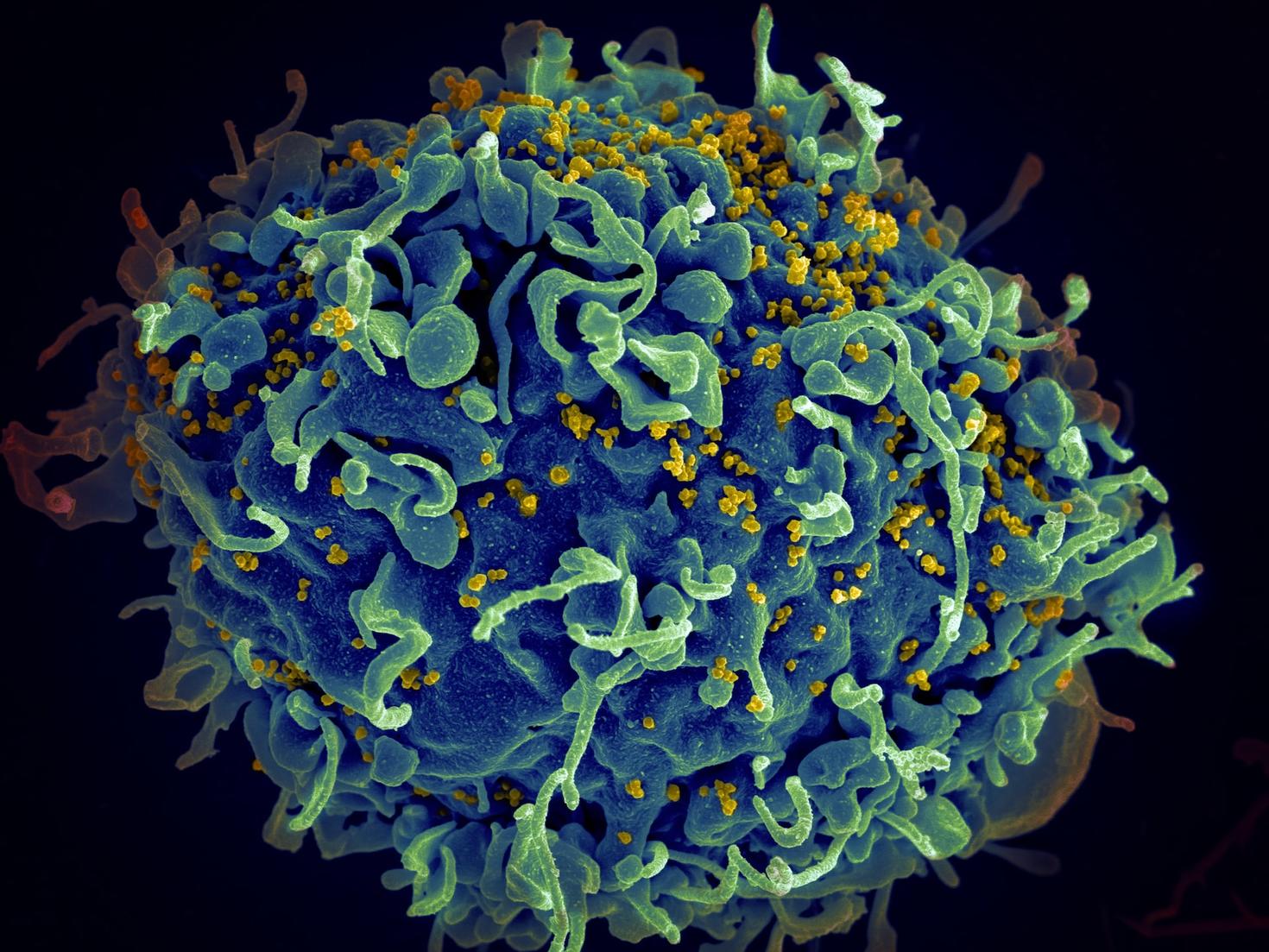 Le VIH, le virus du sida (jaune), infectant une cellule humaine.