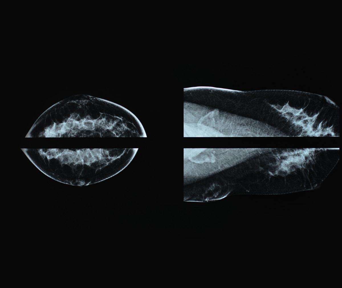 Image radiographique d'une mammographieImage radiographique d'une mammographie
