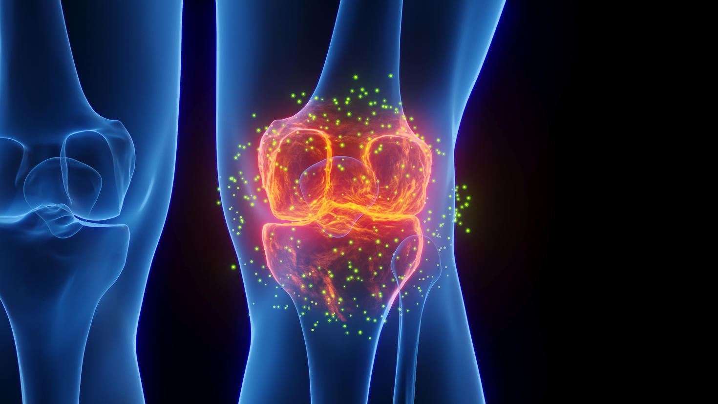 Illustration médicale mettant en évidence l’articulation du genou et les os de la jambe dans des tons bleus et orangés.