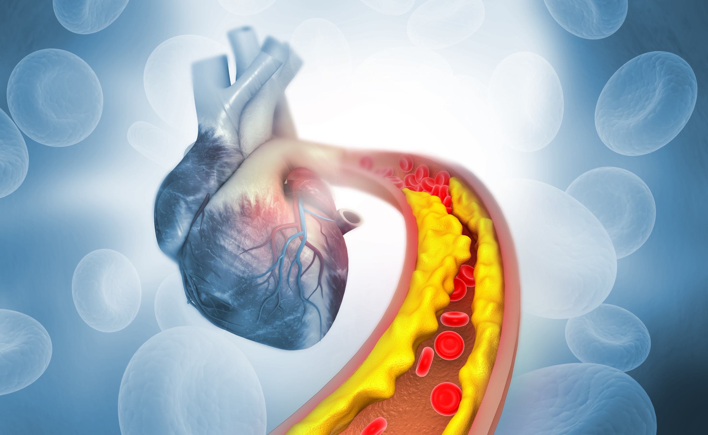 Cholesterol plaque in artery with Human heart anatomy 3d illustration