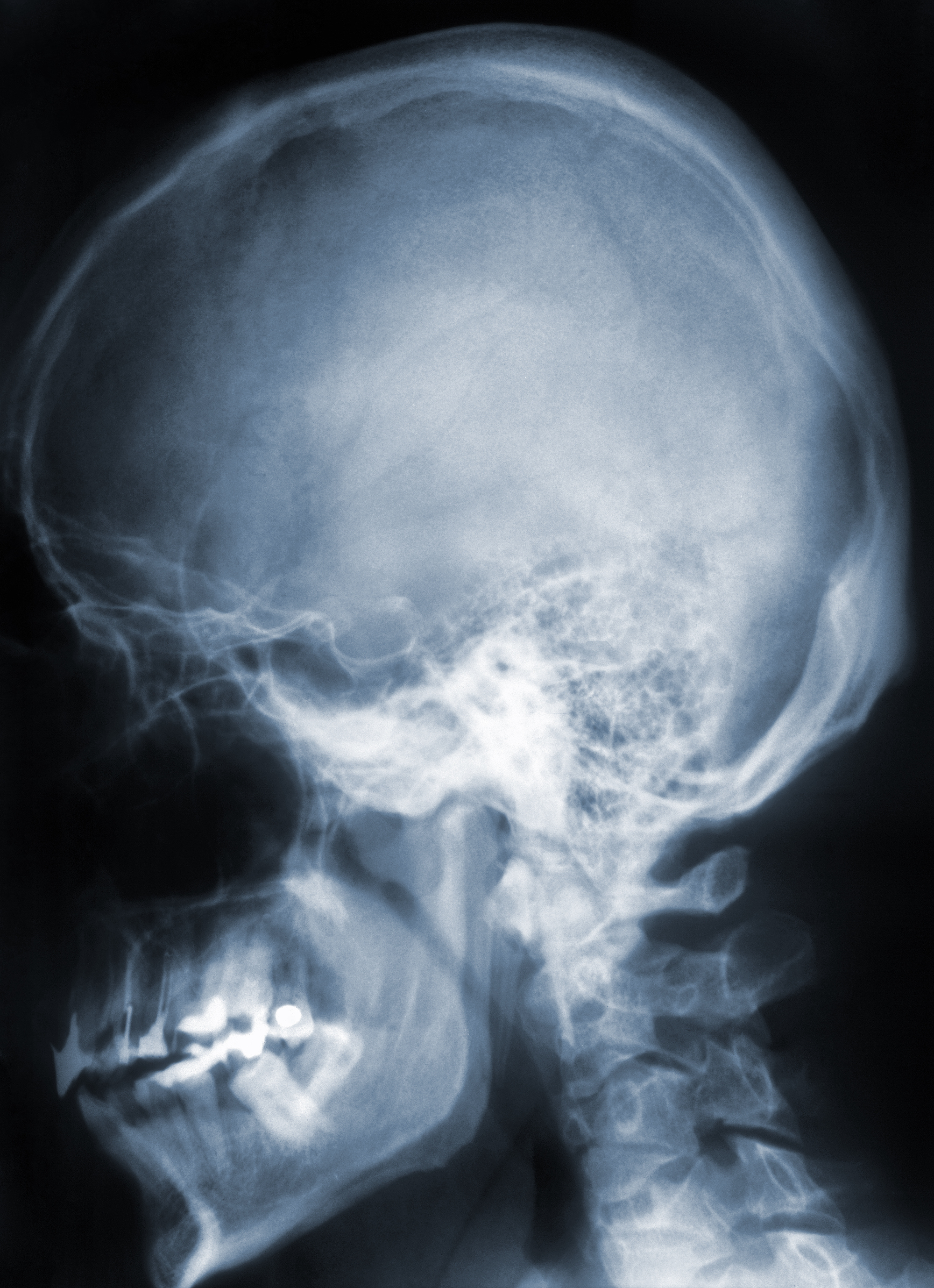 X-ray image of skull, brain and cervical spine, blue toned.