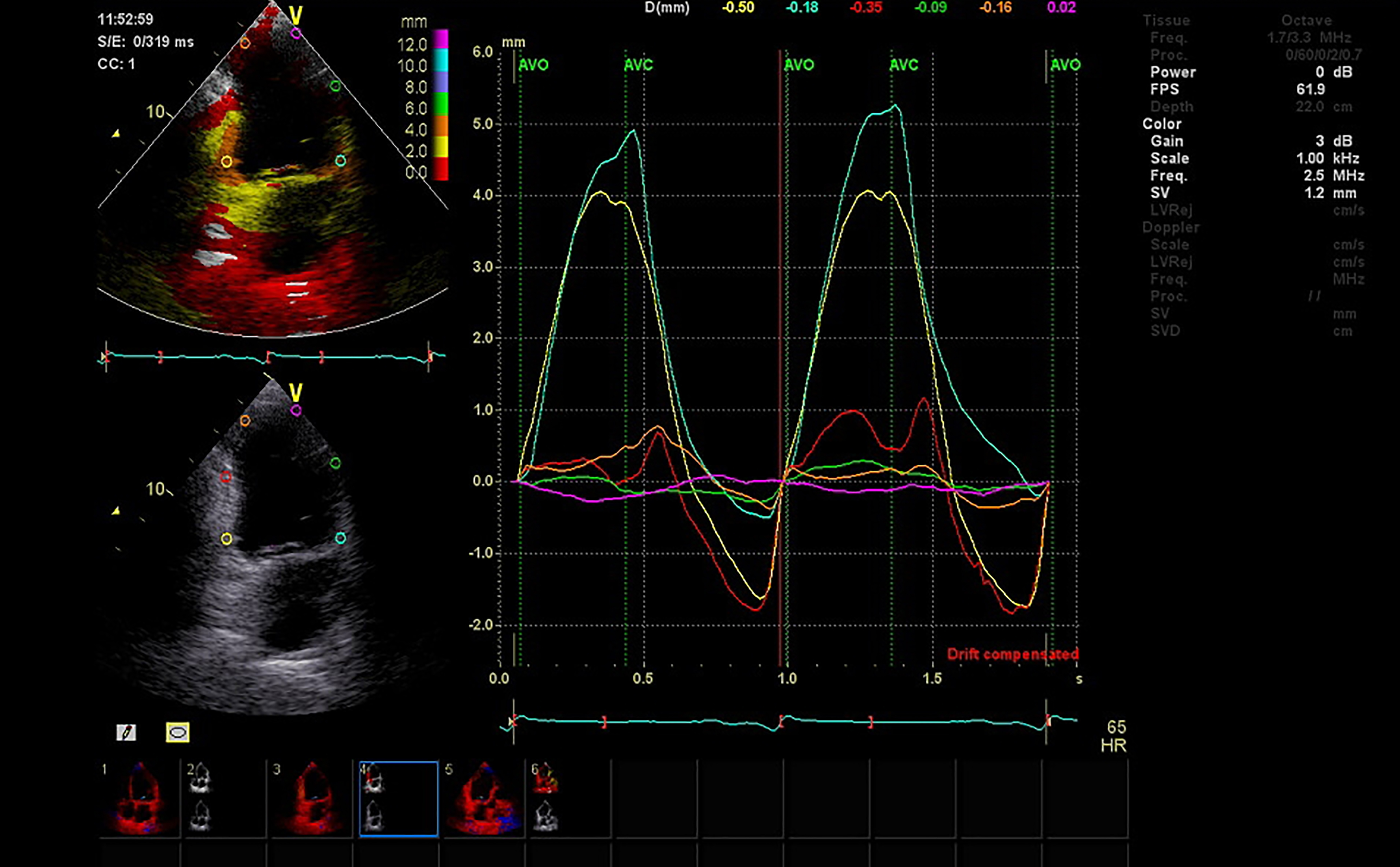 Screen of echocardiography (ultrasound) machine