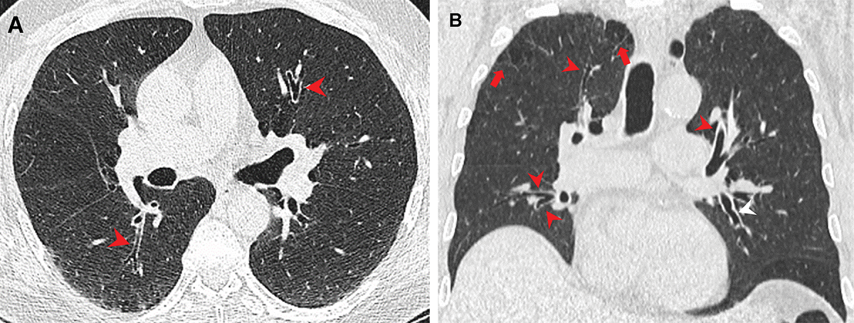 Scan comparison of marijuana and cigarette smoker