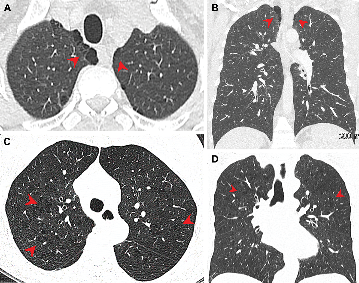 Four scans displaying lungs of marijuana and cigarette smokers