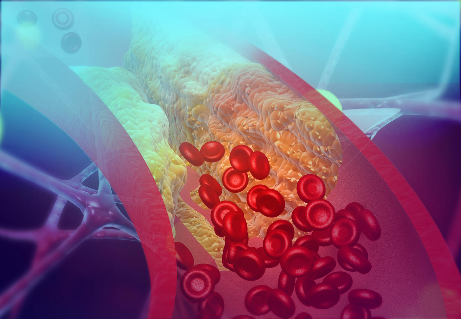 Cholesterol blocking artery 3d illustration