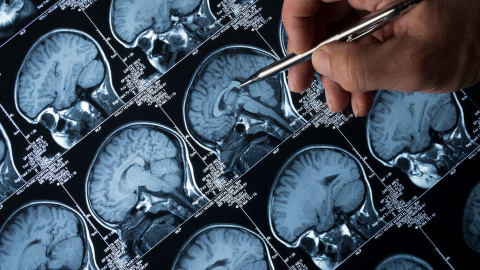 Brain MRI