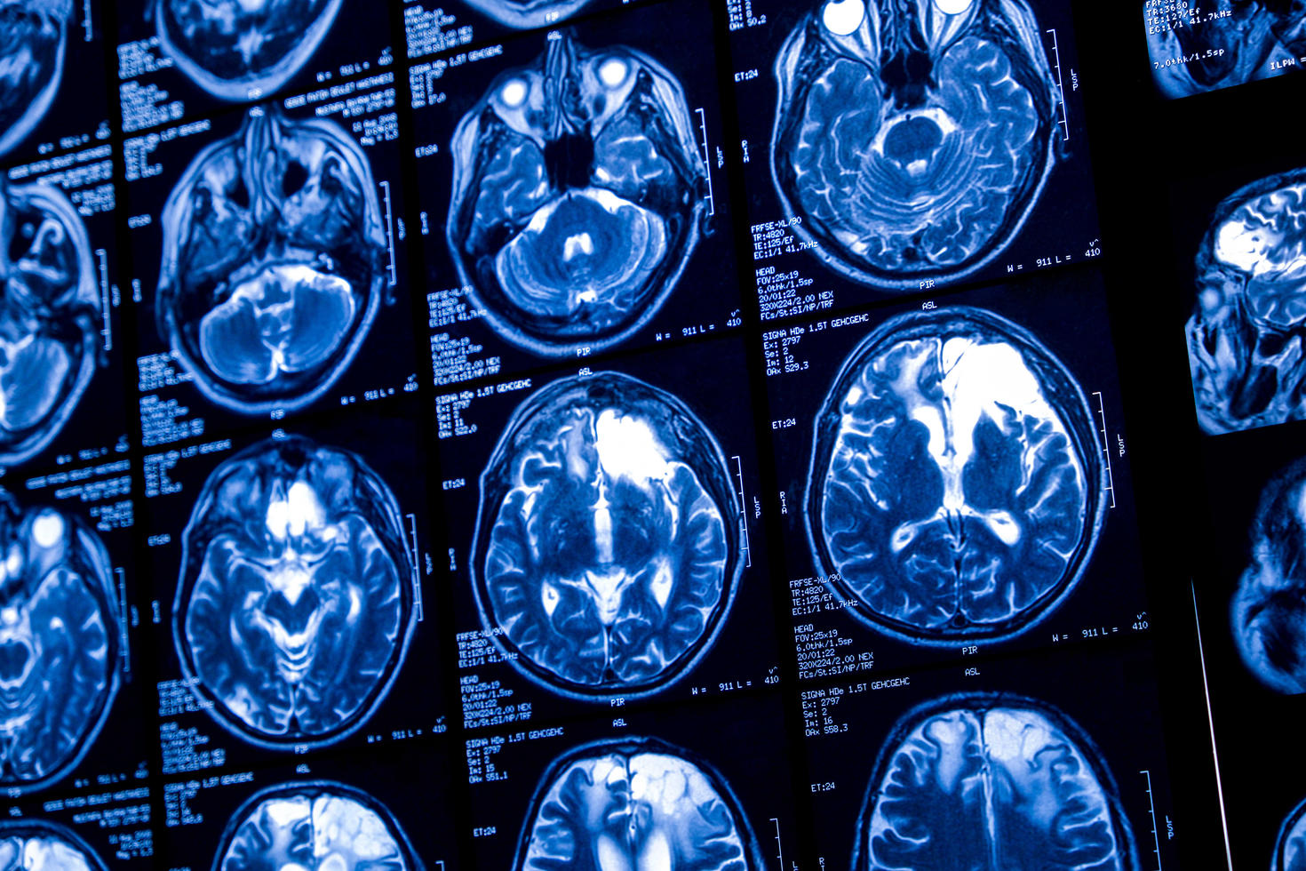 Radiation scan images of brains
