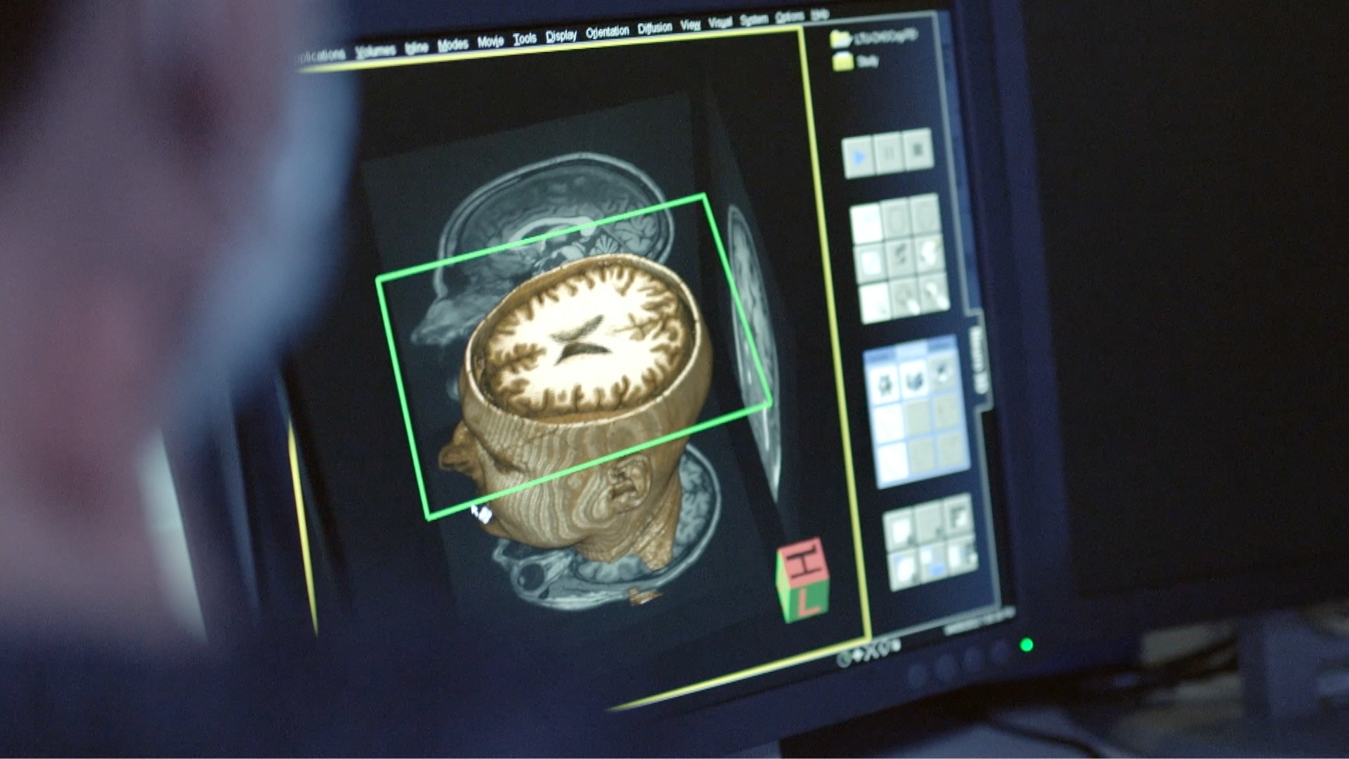 Un écran d’ordinateur affichant un scan médical 3D de la tête et du cerveau humain. 