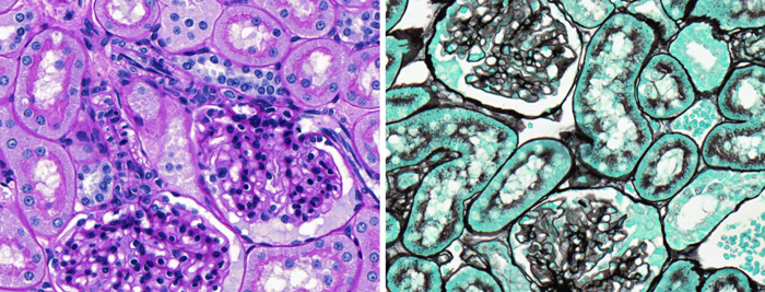 PAS Stain (left) vs Silver Stain (right) showing basement membrane in the glomeruli